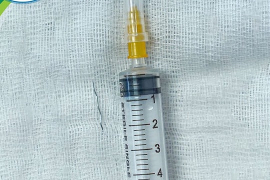 Gắp dị vật kim loại đâm xuyên amidan bệnh nhi hơn 1 tuổi