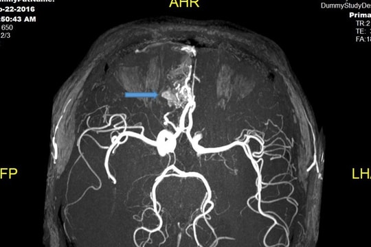 Đi khám, trẻ 14 tuổi mới biết mắc bệnh lạ