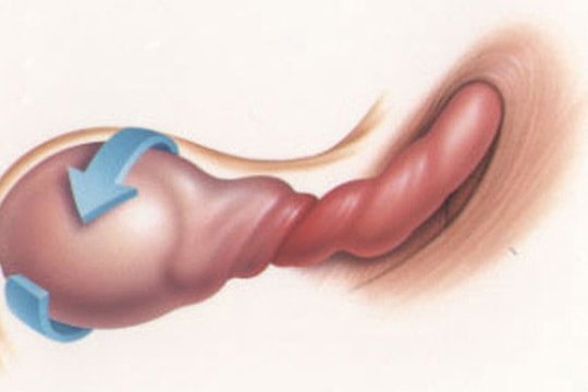 Nam thanh niên cấp cứu vì bị xoắn tinh hoàn