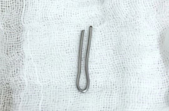 Gắp mảnh kim khí trong đường tiêu hóa bé trai 4 tuổi