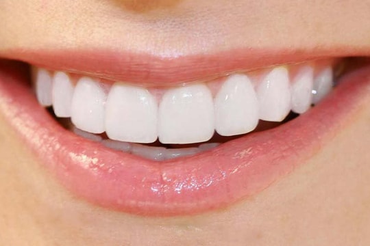 Có nên lấy cao răng hay không?