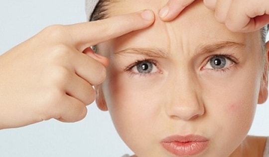 Vì sao tuổi dậy thì thường bị mụn trứng cá, cách chăm sóc thế nào?