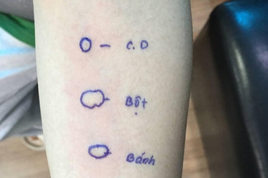 Sốc phản vệ với bột mì do hoạt động thể lực