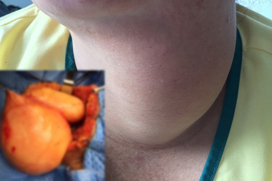 Phẫu thuật lấy bướu cổ to như quả bưởi cho nữ bệnh nhân 