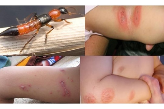 Hà Nội cảnh báo số bệnh nhân tiếp xúc với kiến ba khoang ngày càng tăng