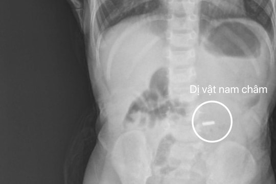 Gắp dị vật nam châm ở tá tràng cho bé trai 18 tháng tuổi