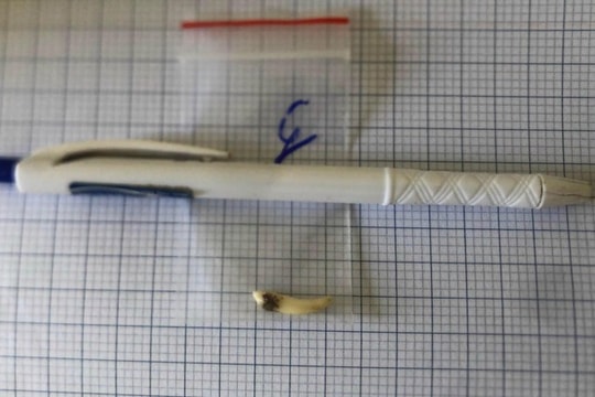 Tá hóa khi biết có răng mọc trong hốc mũi sau khi đi khám 