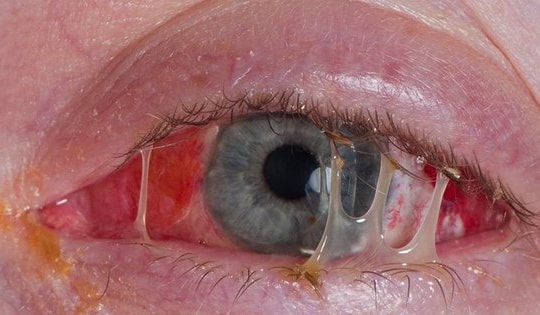 Viêm kết mạc nên dùng thuốc gì?