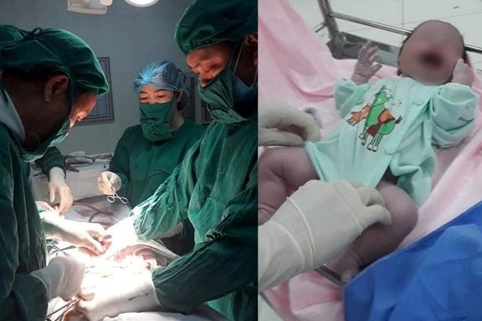 Phẫu thuật cấp cứu sản phụ và thai nhi bị sa dây rốn