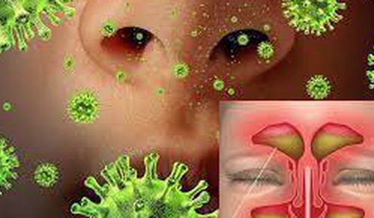 Viêm mũi xoang cấp tính cần phân biệt với bệnh nào?