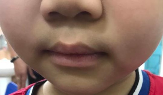 Lạm dụng thuốc xịt mũi khiến trẻ suy tuyến thượng thận