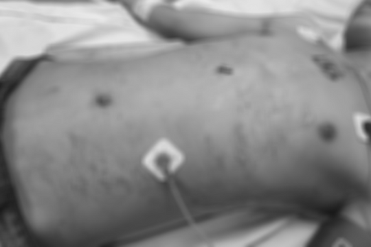 Cứu sống thiếu niên bị bạn đâm thấu bụng trong đêm