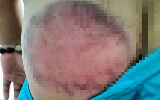 Học sinh lớp 4 bị giáo viên chủ nhiệm đánh bầm tím mông