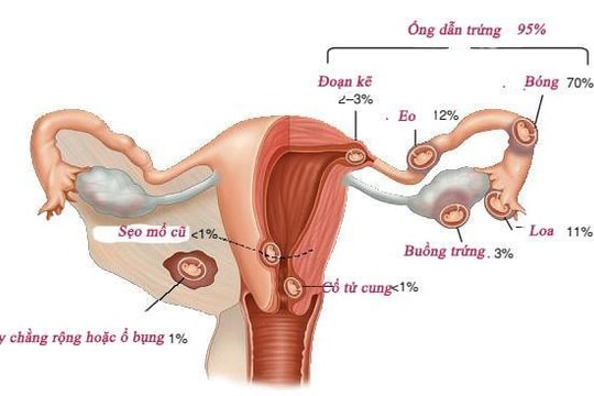 Mang thai ngoài tử cung có nguy hiểm không?