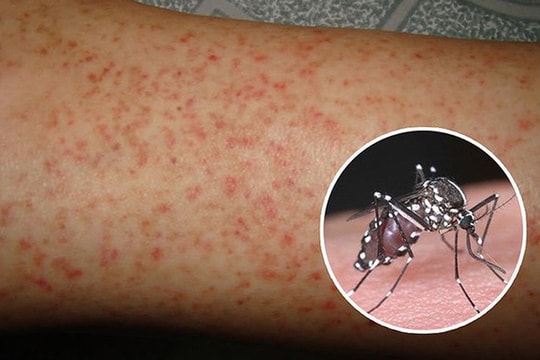 Sốt xuất huyết diễn biến phức tạp tại Hà Nội, chuyên gia lưu ý cách chăm sóc tại nhà