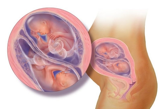 Các biến chứng nguy hiểm khi mang đa thai