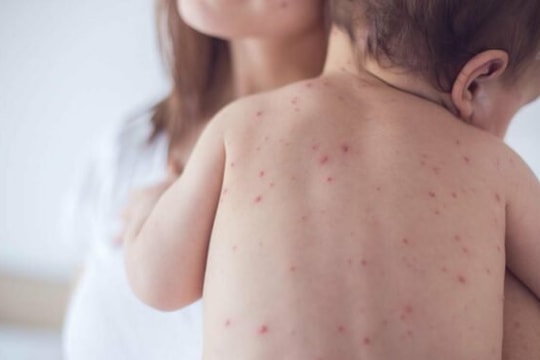 Dấu hiệu cảnh báo nguy hiểm của sốt xuất huyết ở trẻ em