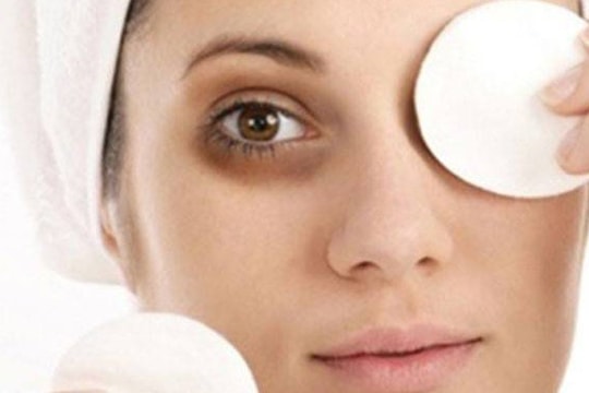 Cách giảm quầng thâm mắt