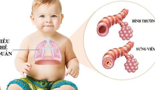 Viêm tiểu phế quản cấp ở trẻ khi thời tiết giao mùa