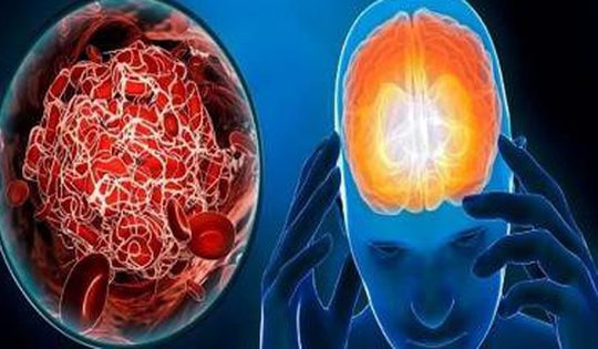 8 thay đổi lối sống giúp ngăn ngừa đột quỵ