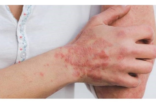 Cẩn trọng với các bệnh lý ngoài da khi thời tiết hanh khô