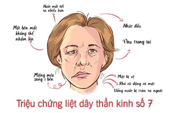 Liệt dây thần kinh số 7 ngoại biên và cách điều trị