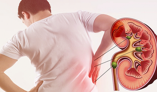 5 phương pháp lấy sỏi thận ra khỏi cơ thể hiệu quả