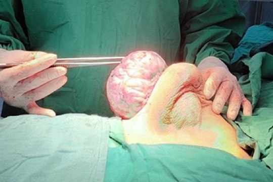 Bóc tách khối u vú 'khổng lồ' cho thiếu nữ 15 tuổi