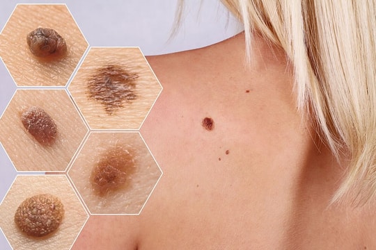 Các yếu tố làm tăng nguy cơ ung thư da