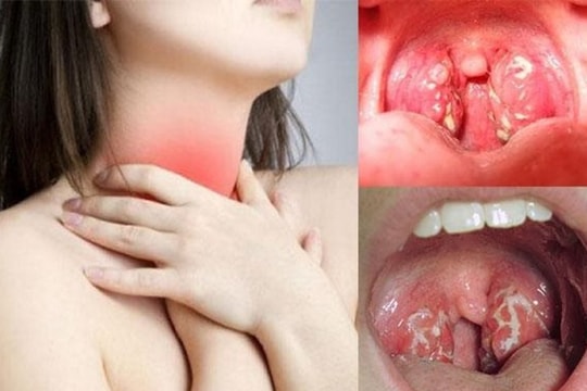 Viêm họng hạt có mủ và cách điều trị