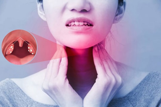 Viêm amidan mạn tính và cách điều trị