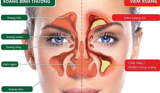 Nhận biết nguyên nhân và điều trị viêm xoang hàm