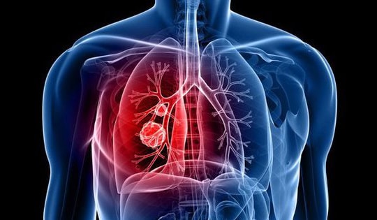 Chẩn đoán ung thư phổi bằng cách nào?