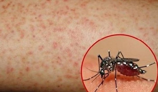 Ăn gì hỗ trợ tăng tiểu cầu trong bệnh sốt xuất huyết?