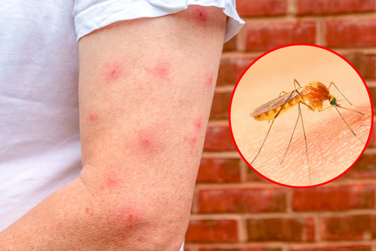 Các biện pháp phòng ngừa muỗi cắn gây bệnh sốt xuất huyết