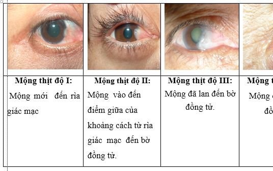 Mộng thịt ở mắt và cách điều trị