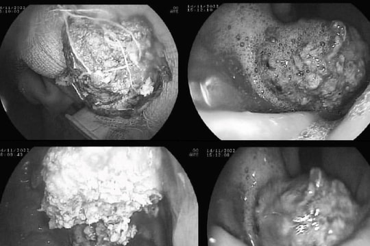 Người phụ nữ bị tắc ruột sau khi ăn 1kg hồng giòn