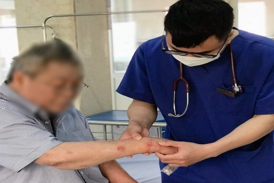 Cụ ông 79 tuổi bị suy tuyến thượng thận do tự ý sử dụng thuốc Corticoid