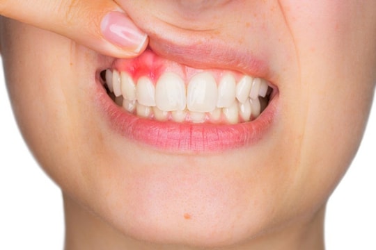 Áp xe nha chu và cách phòng ngừa