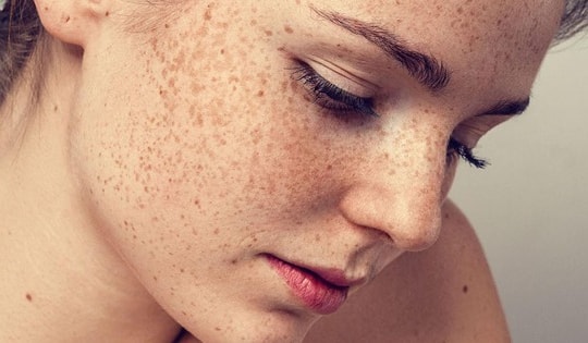 Lột da trị nám thần thánh và cảnh báo từ bác sĩ da liễu