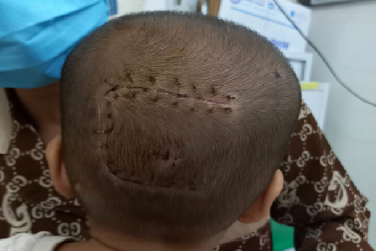 Phẫu thuật khối u màng não cho bệnh nhi 30 tháng tuổi