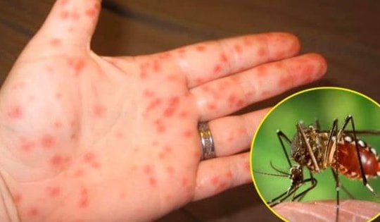 Bộ Y tế: Đã có hơn 314.000 ca mắc sốt xuất huyết, 115 ca tử vong, dự báo dịch tiếp tục diễn biến phức tạp