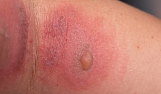 Đề phòng viêm da do tiếp xúc với côn trùng khi thời tiết chuyển mùa