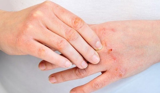 Trời rét, người bị viêm da cơ địa cần chăm sóc thế nào?