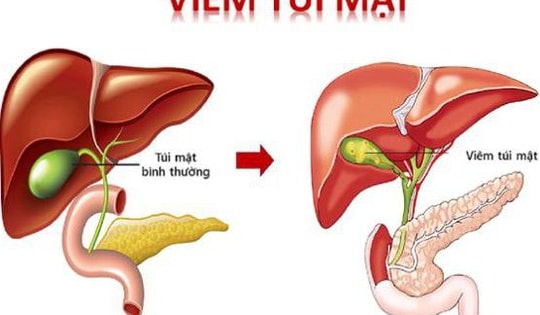 6 huyệt vị hỗ trợ điều trị viêm túi mật