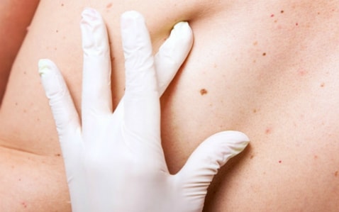 Phát hiện ung thư từ nốt ruồi có dấu hiệu bất thường