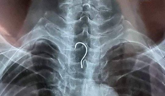 Gắp lưỡi câu mắc trong thực quản cụ già 83 tuổi