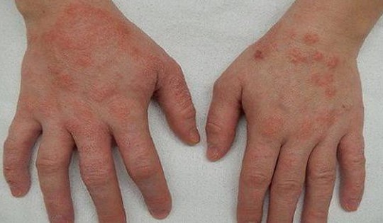 Vì sao viêm da cơ địa dễ tái phát vào mùa lạnh?