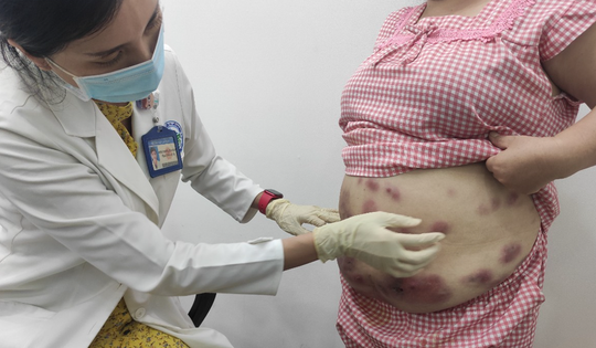 Tiêm tan mỡ bụng, người phụ nữ bị áp xe viêm, chảy mủ