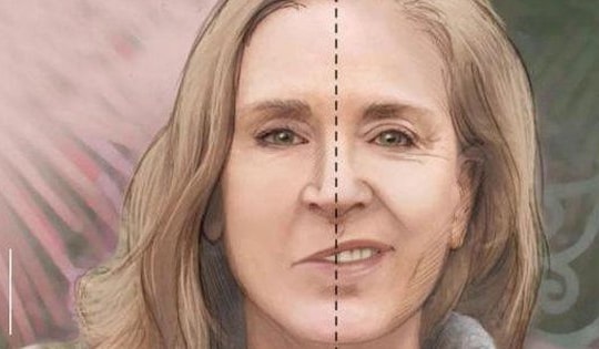 Trời lạnh, đề phòng méo miệng, liệt dây thần kinh số 7 ngoại biên